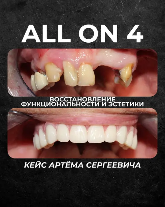 All-on-4, кейс