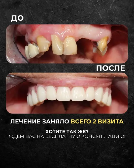 All-on-4, результат за два визита