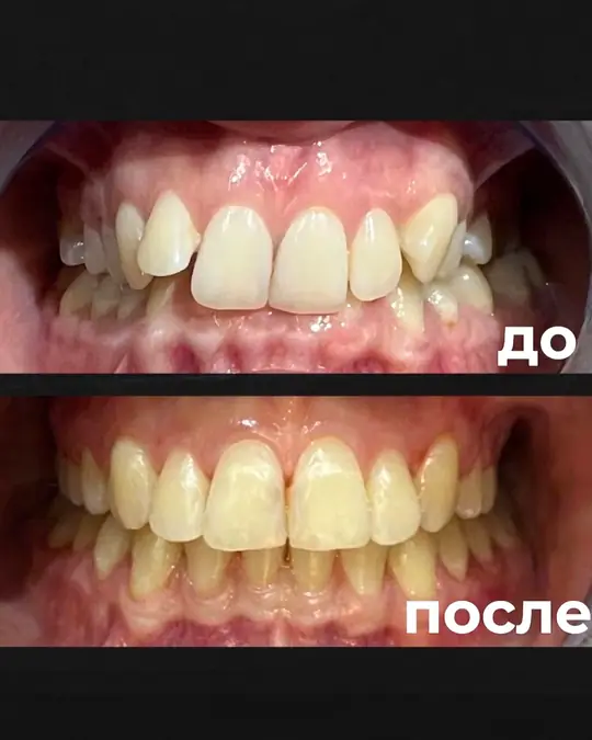 Брекеты, до