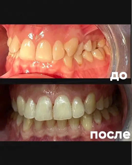 Брекеты, после