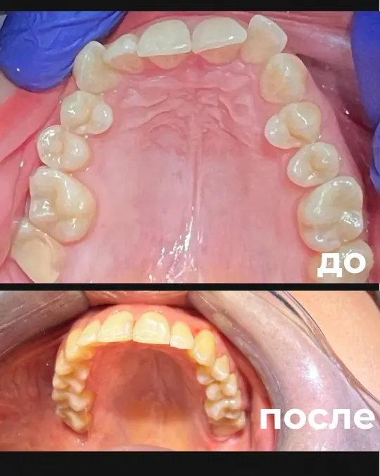 Брекет-кейс, этапы