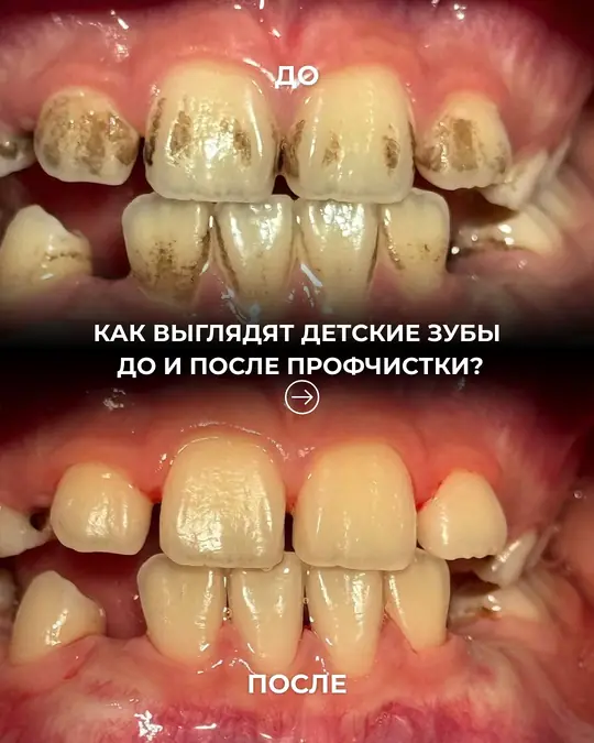 Детские зубы до и после профчистки