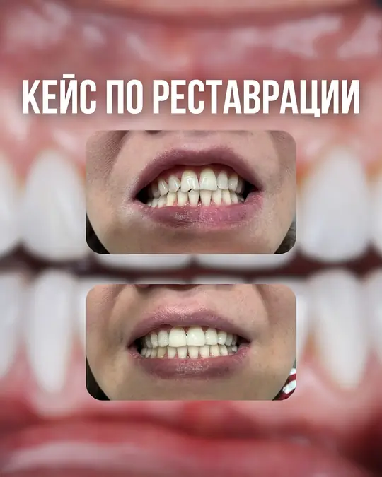Реставрация передних зубов, до и после