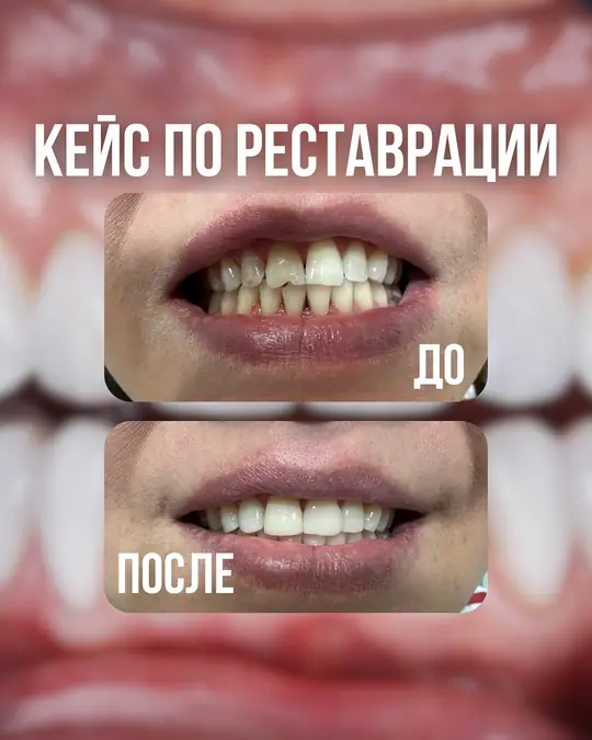 Реставрация, до и после